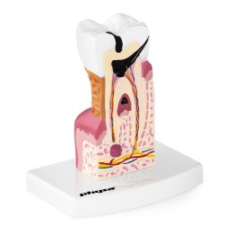 Model anatomiczny chorego zęba człowieka w skali 6:1 Physa